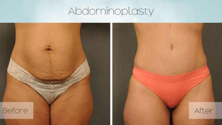 Things You Should Know About Abdominoplasty or ‘Tummy Tuck’