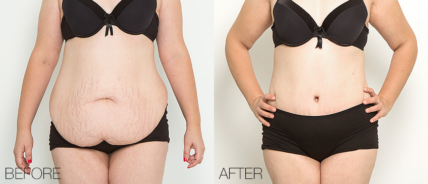 Before & After Abdominoplasty to remove hanging skin - Dr
